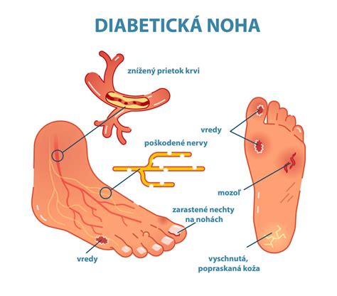 Infografika: Časti nohy a ponsetiho liečba
