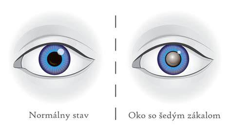 Infografika: Čo je šedý zákal a aké sú štádiá