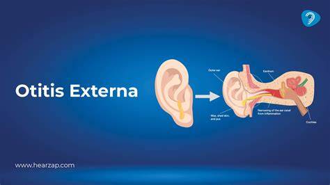 Infografika znázorňujúca Otitis externa a anatomiu zvukovodu