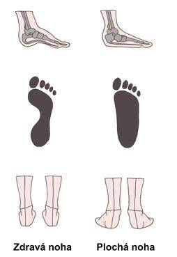 Infografika: anatomia klenby nohy a typy plochej nohy