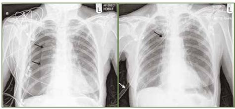 RTG snímka hrudníka s viditeľnou hiátovou herniou