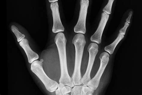 Röntgenový snímok pľúc psa s nádorom