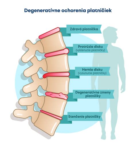 Schematické znázornenie chrbtice jazvečíka s vyznačením problémových platničiek