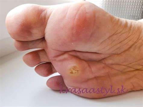 Pes s akrálnym lízacím granulómom na nohe