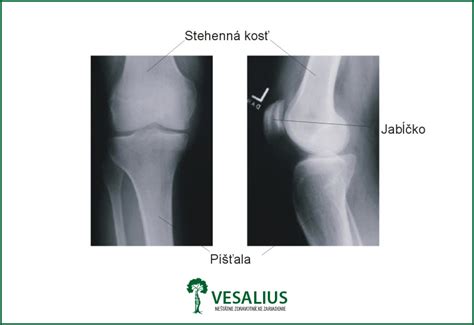 Ilustrácia znázorňujúca zdravý a poškodený kĺb
