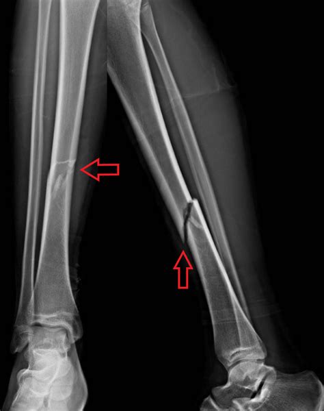 Rentgen psacej nohy so zlomeninou