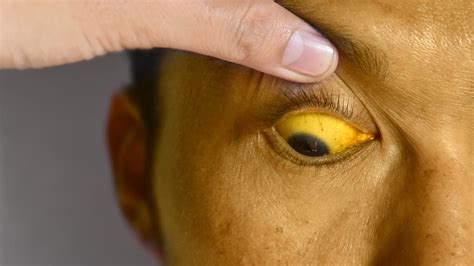 Pes s príznakmi žltačky