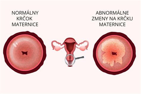Infografika zobrazujúca proces zmeny krčka maternice