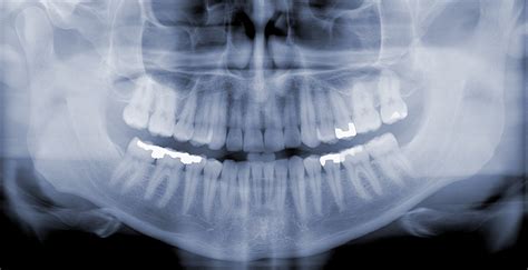 RTG snímka psa s cudším telesom v tráviacom trakte
