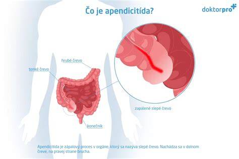 Infografika: Zobrazenie čreva psa a bežné príčiny zápalu tráviaceho traktu