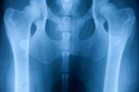 Obrázok ilustrujúci anatomickú stavbu bedrového kĺbu a diagnostické RTG snímky