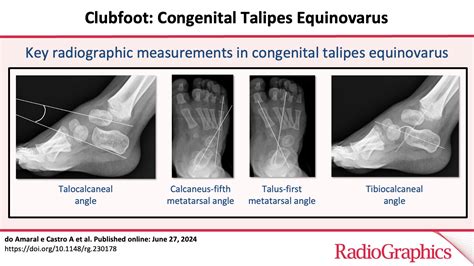 Ilustrácia chodidla s pes equinovarus
