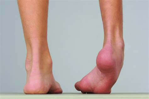 Schematické znázornenie deformít pri pes equinovarus