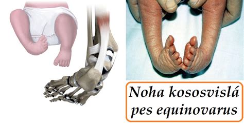 Porovnanie zdravej nohy a nohy s pes equinovarus