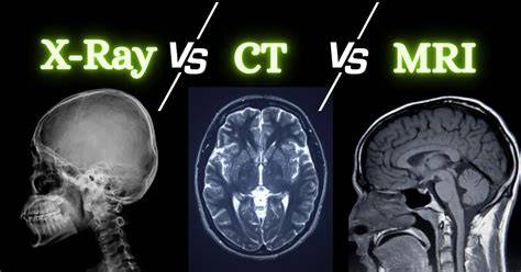 Infografika: Postup diagnostiky otras mozgu a rozdiely CT vs MRI