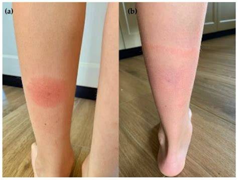 Infografika: Rozdiel medzi alergickou reakciou, lokálnym podráždením a erythema migrans