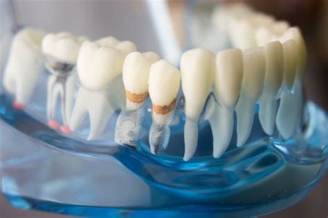 Zubný kameň na psovi