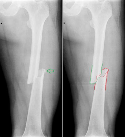 RTG snímok zlomeniny čelusti psa