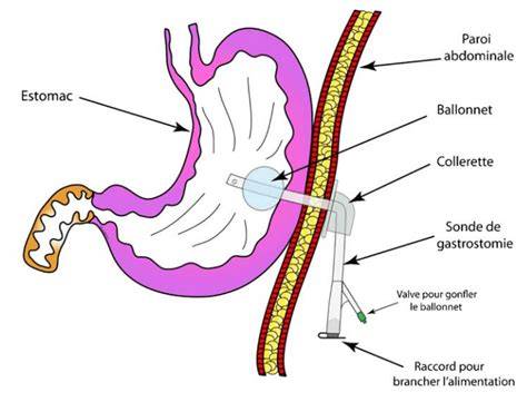 Schéma gastropexie ako preventívneho zásahu