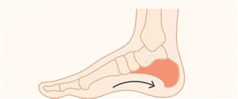 Infografika ukazujúca anatomiu nohy pri pes cavus a rozloženie tlaku