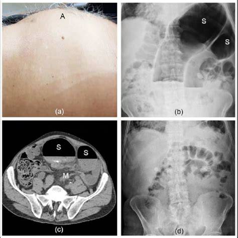 distended abdomen ультразвуковая диаграмма з voľnou tekutinou v brušnej dutine