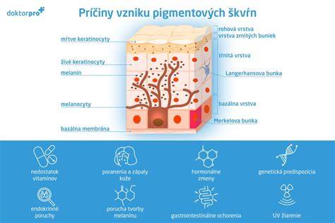 Infografika: Typy pigmentových škvŕn a ich príčiny