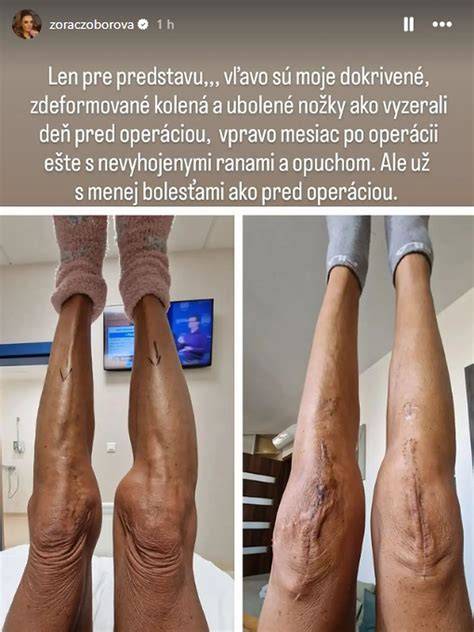 Schéma rehabilitačného programu po operácii DBK