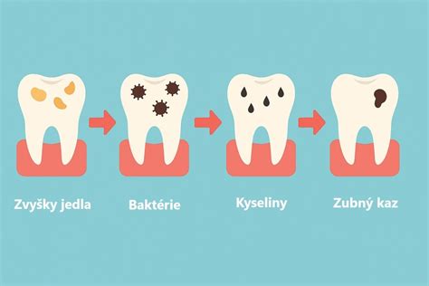 Infografika: ako vzniká zubný kameň a jeho štádiá
