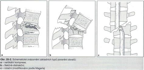 Schematické znázornenie miechy a stavcov