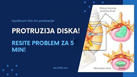 Schéma prolapsusu žľazy tretieho viečka a protrúzie