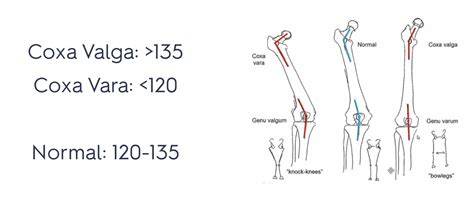 Obrázok: anatomické rozdiely normálneho kĺbu a dysplastického kĺbu
