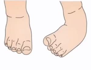 Vrodená deformita chodidla - pes equinovarus