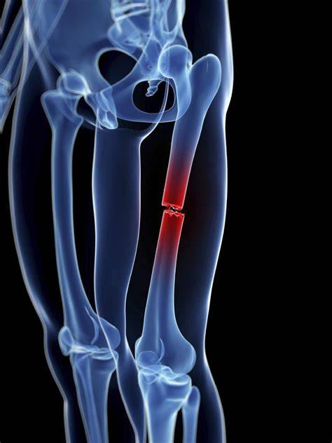 Infografika: Priebeh rehabilitácie po zlomenine stehennej kosti