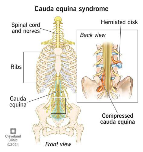 Diagramické zobrazenie cauda equina a orientácia nervov v bedrovej oblasti