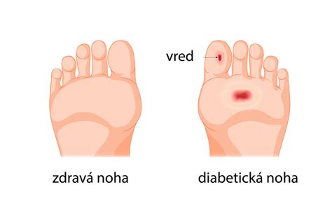 Infografika: Schéma diabetickej nohy a rozlíšenie typov rán