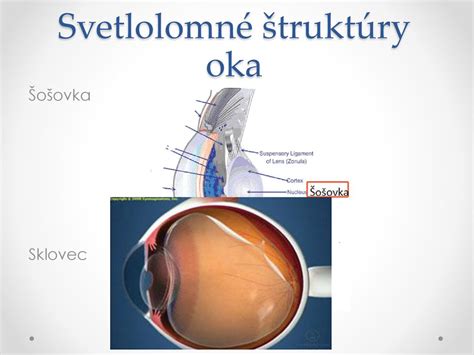 Ilustrácia štruktúry oka s kataraktou