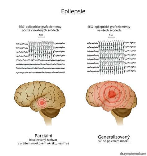 Infografika: typy epilepsie u psov a ich priebeh
