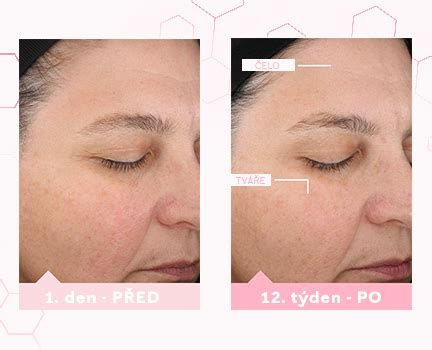 porovnanie pleti pred a po použití čiernej masky