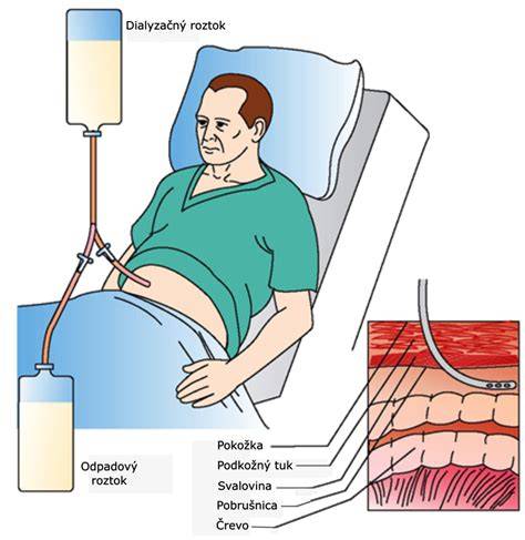 Illustračná schéma brušnej dutiny s ascitom a distendovaným abdomenom
