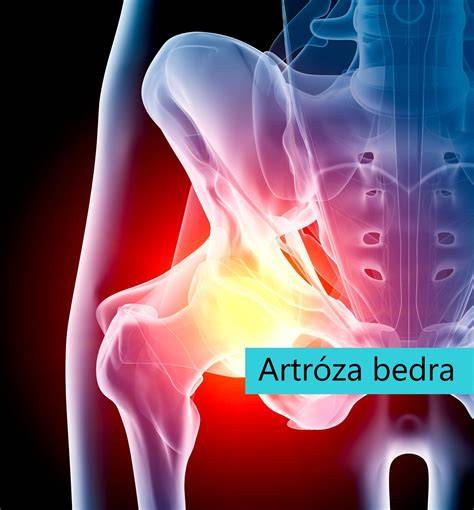 Infografika o anatomii bedrového kĺbu a mechanizme dysplázie
