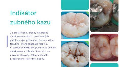 zubny-kamen-infografika